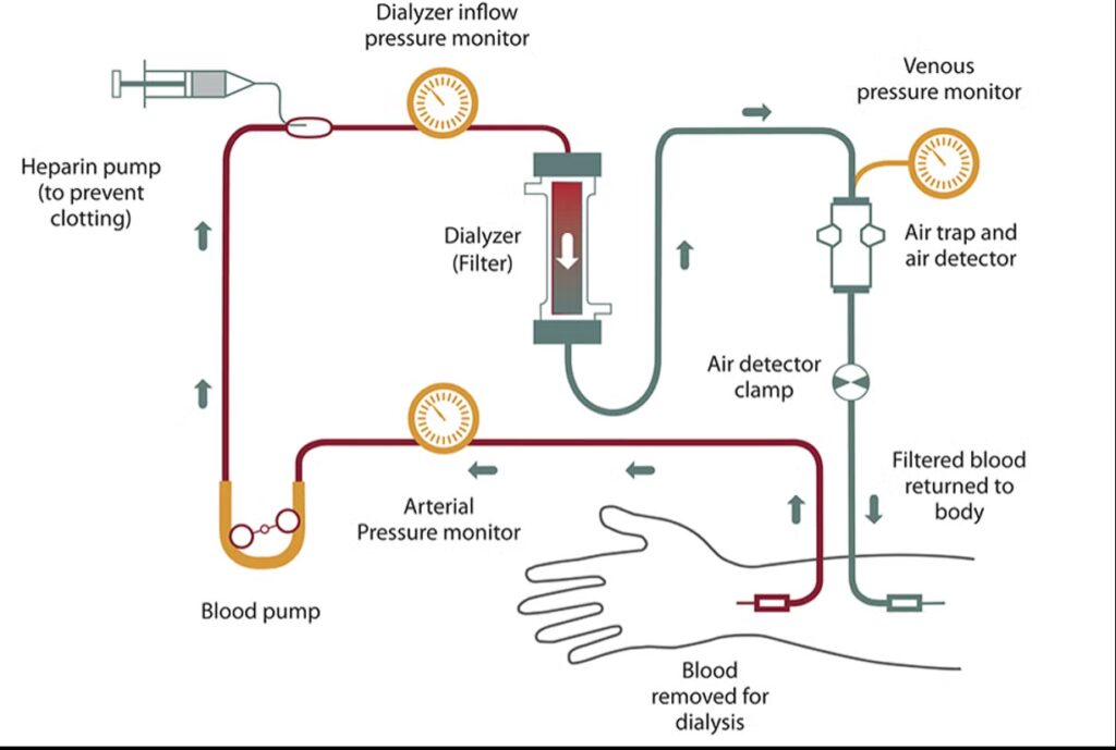 Hemodialysis (HD)